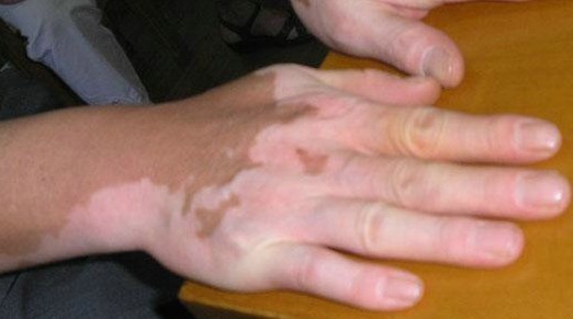 手部白癜风治疗要综合考虑治疗方案