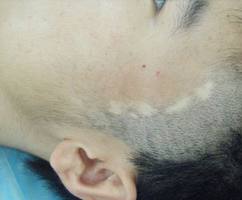 白癜风是一种自发性黑色素退化的皮肤病