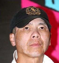 男性白癜风